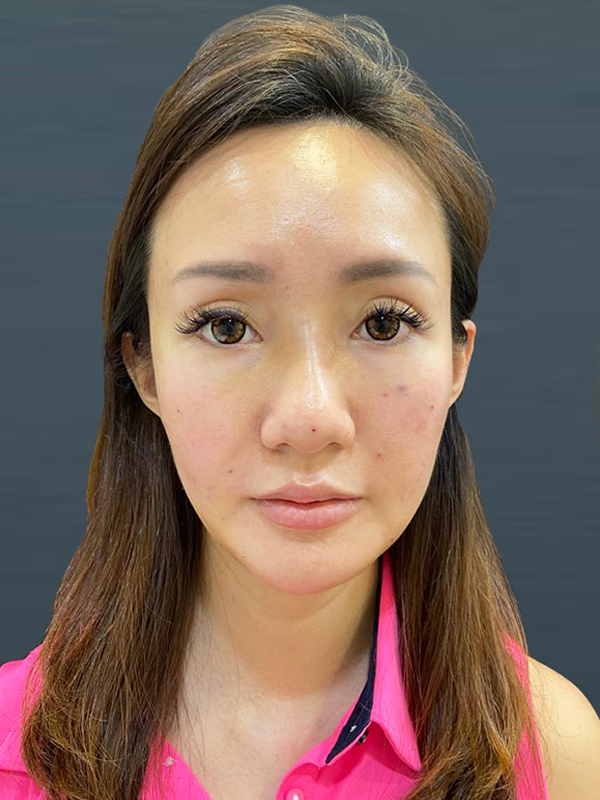 Full Face Fascia Resculpting